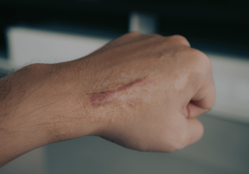 scar-on-human-skin-keloid-on-hand-2022-12-16-03-36-38-utc-1-1-e1683900725848-min