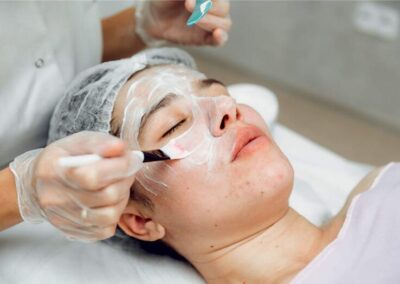 peeling chemiczny