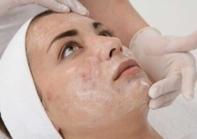 peeling chemiczny twarzy